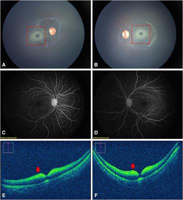 Multimodal optical imaging and genetic features of AB variant GM2 gangliosidosis: a case report